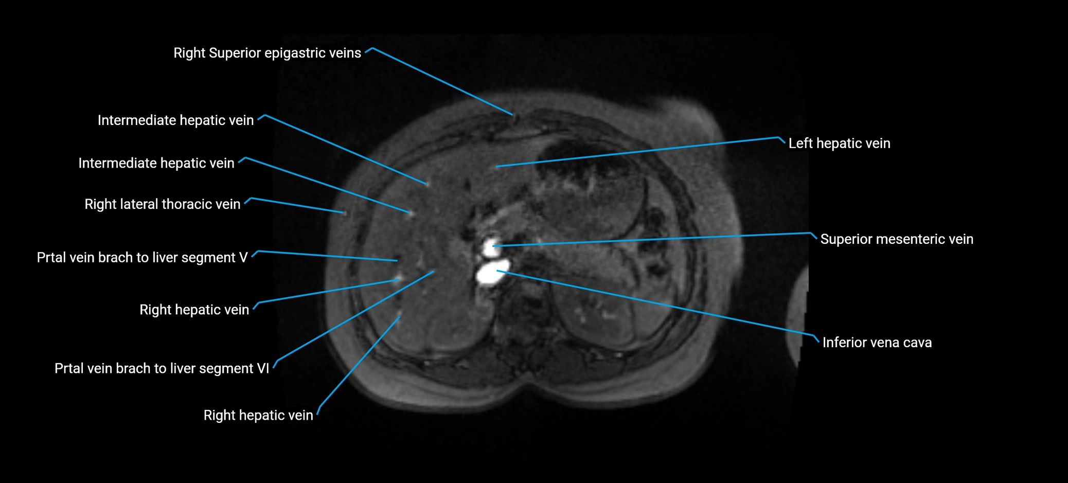 MRV abdomen pelvis & lower limb axial cross sectional anatomy labelled MRI image 49 (1).webp